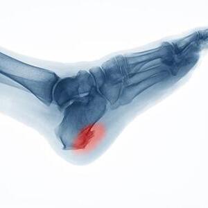 발바닥의 통증, 족저근막염(Plantar fasciitis)