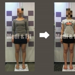 최○○회원님 before&after [메디앤핏 약수점]