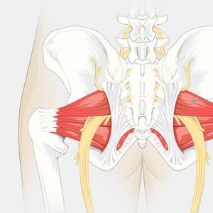 이상근 증후군(piriformis syndrome)
